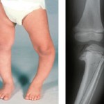 blount disease in children picture