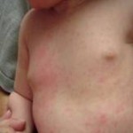 Roseola Rash in Toddlers