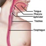 dysphagia in children