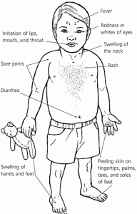 kawasaki disease symptoms